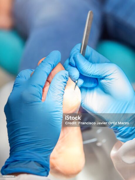 Close-up of a podiatry treatment. Selective focus